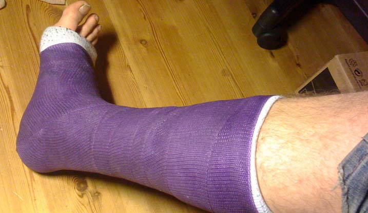 Stag Party Pranks The Broken Leg The Stags Balls