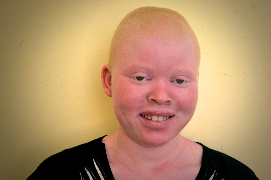 Saving Grace Albinism photo 2