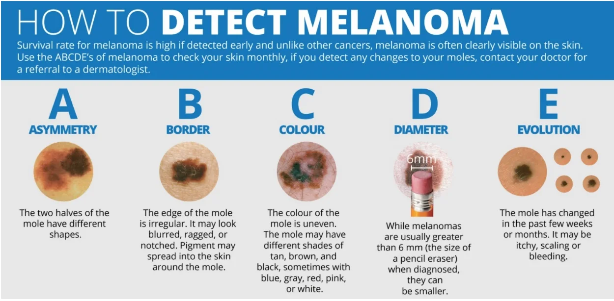 ABCDE method of melanoma detection. Credit: www.melanomanetwork.ca  