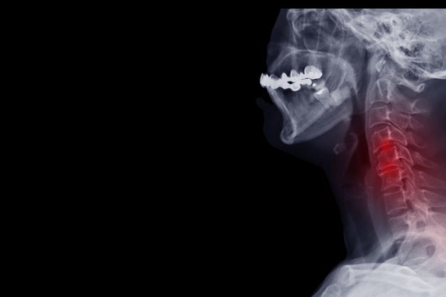 Spondylosis can cause numbness and tingling on the left or right side of your body