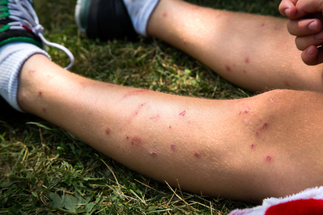 Insect bites can become infected and need treatment