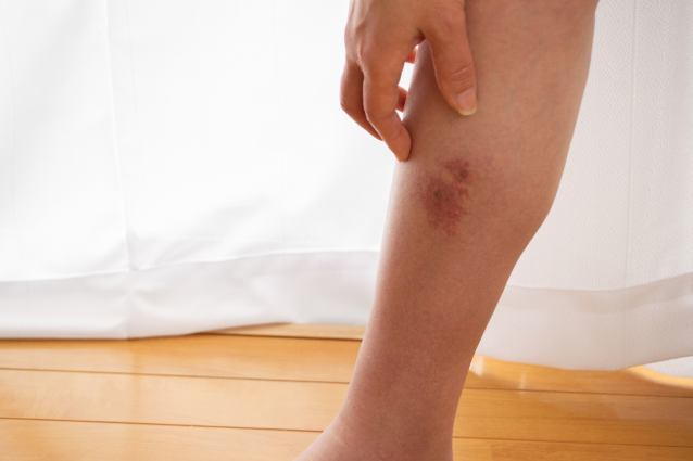 Infected insect bite can cause cellulitis 
