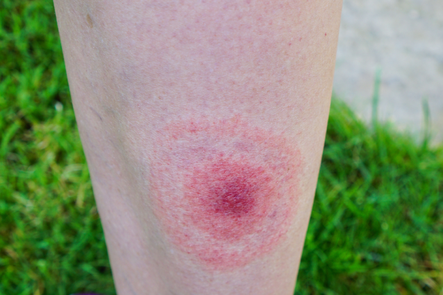 Tick bites can lead to an infection like Lyme disease, which may cause a big circular rash on your skin that looks like a ‘bull’s eye’ on a dartboard