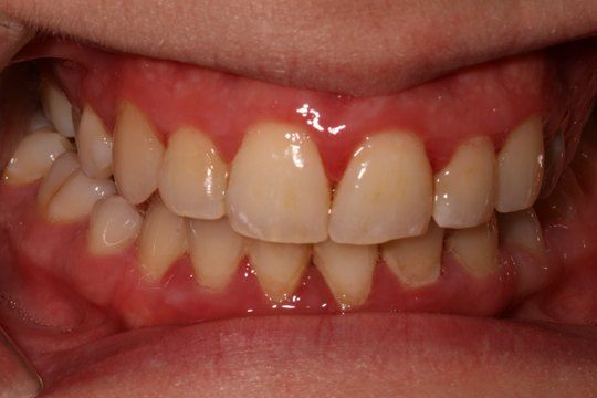 periodontal-disease-02
