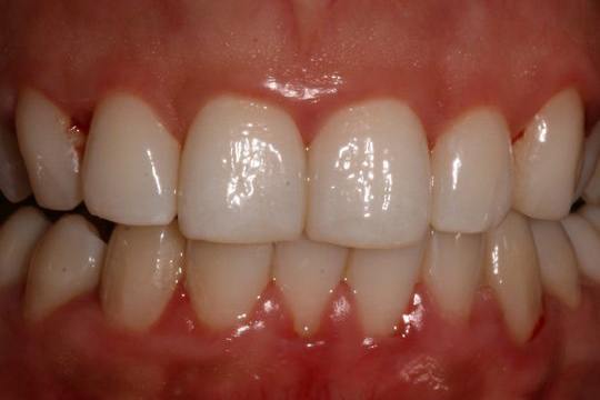 periodontal-disease-01