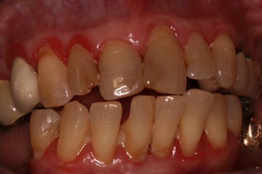 periodontal-disease-03