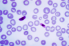 Blood smear showing Plasmodium Falciparum, the parasite which causes malaria (commons.wikimedia.org)